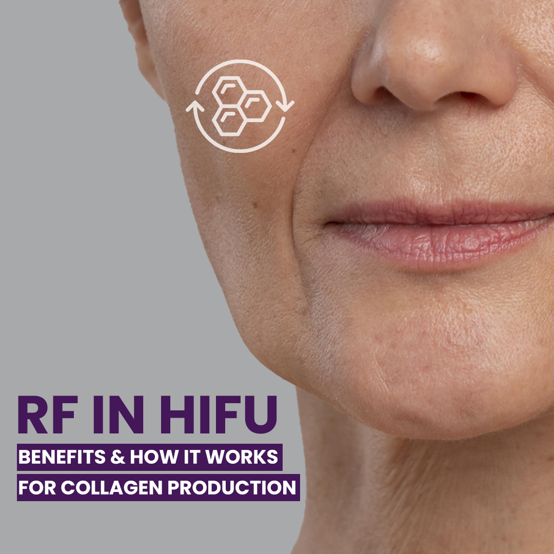 RF in HIFU: Benefits and How It Works for Collagen Reproduction?