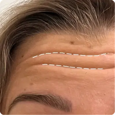 Reduce Wrinkles, Frown, Smile, and Neck Lines