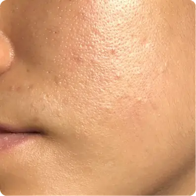 Improve Skin Texture, Pigmentation & Glow