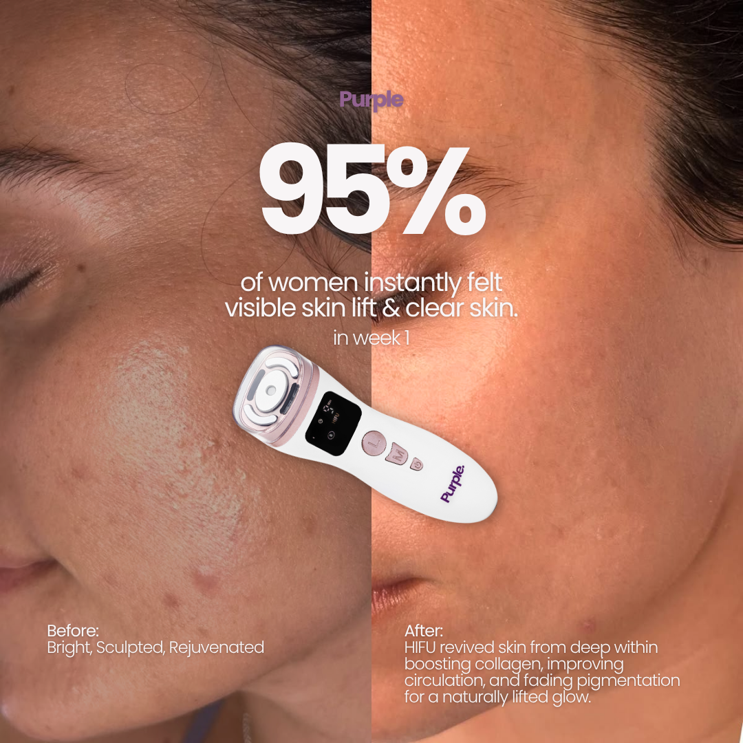 Hifu Anti Wrinkle Device