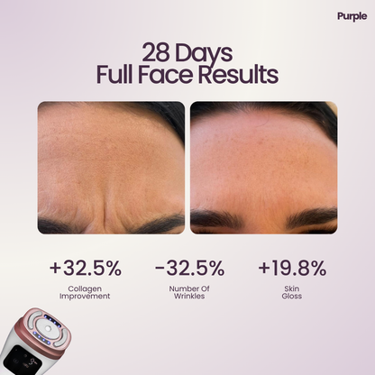 Hifu Anti Wrinkle Device