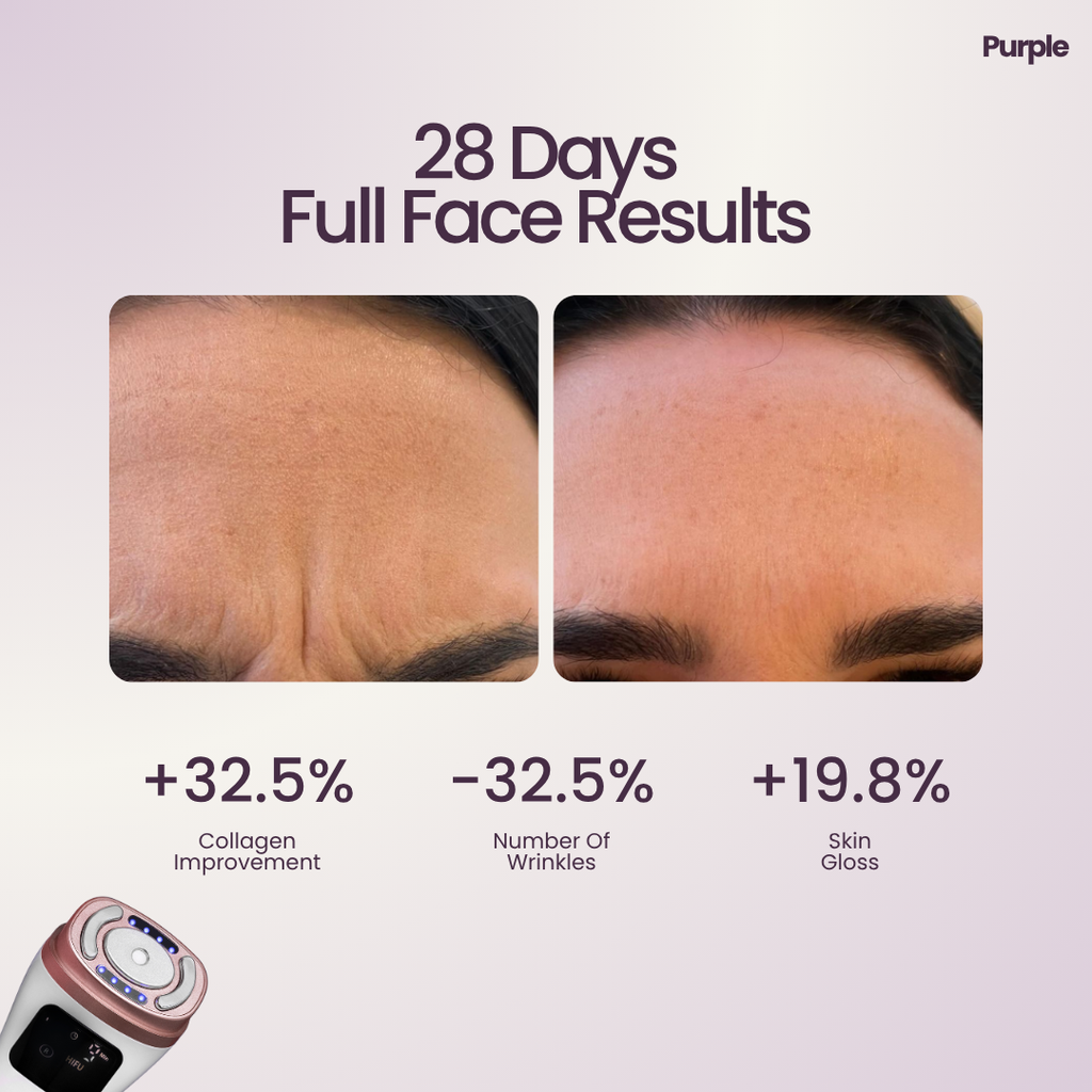 Hifu Anti Wrinkle Device