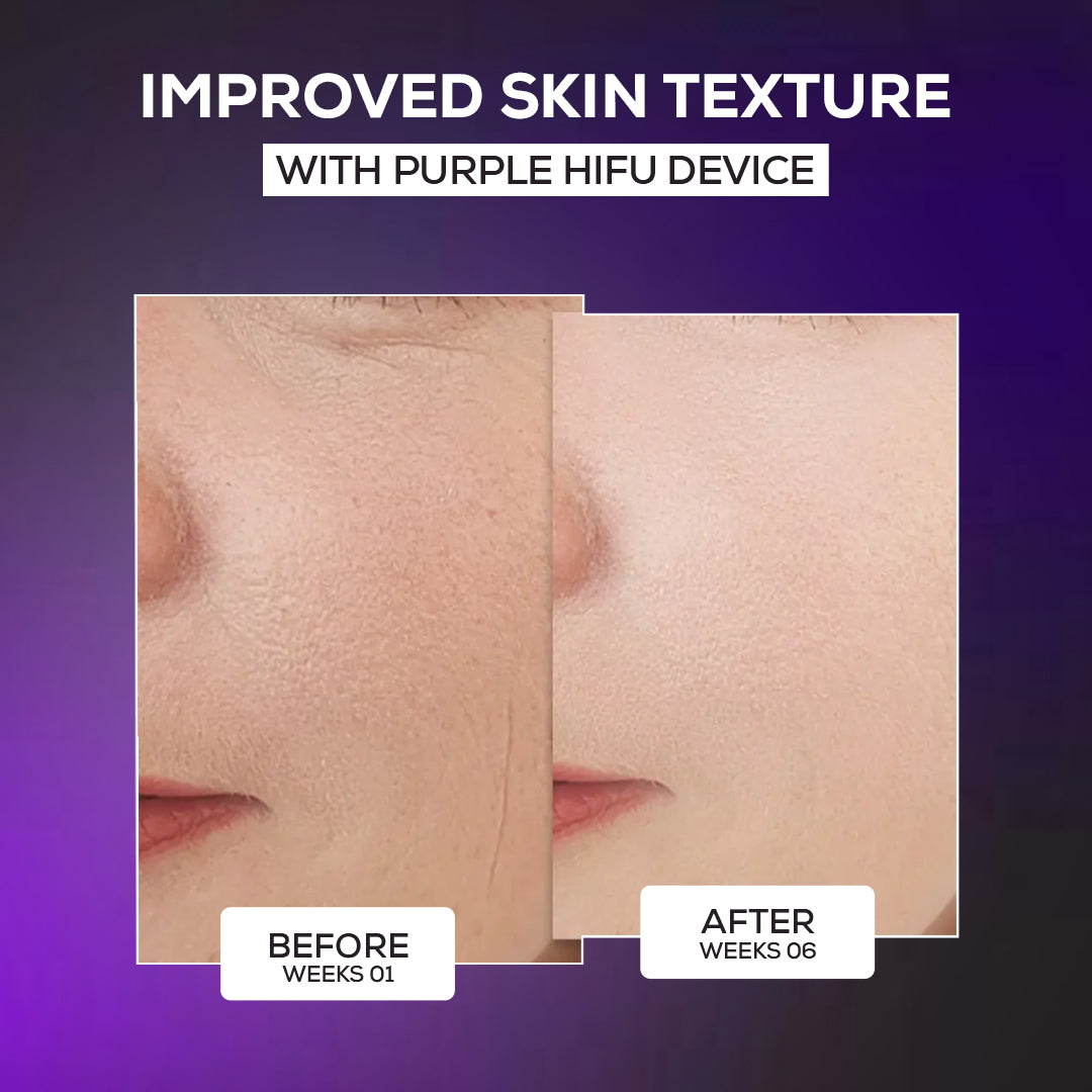 Hifu Anti Wrinkle Device