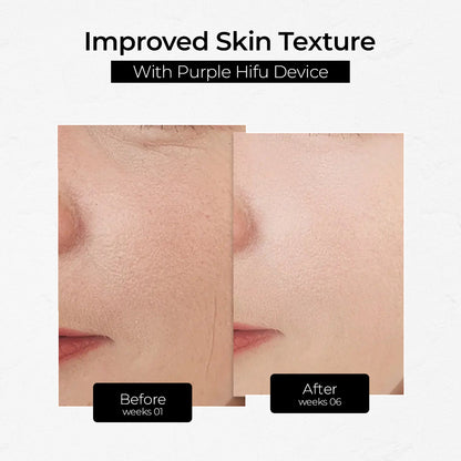 Hifu Anti Wrinkle Device