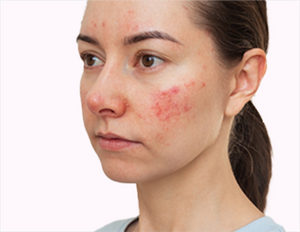 pigmentation